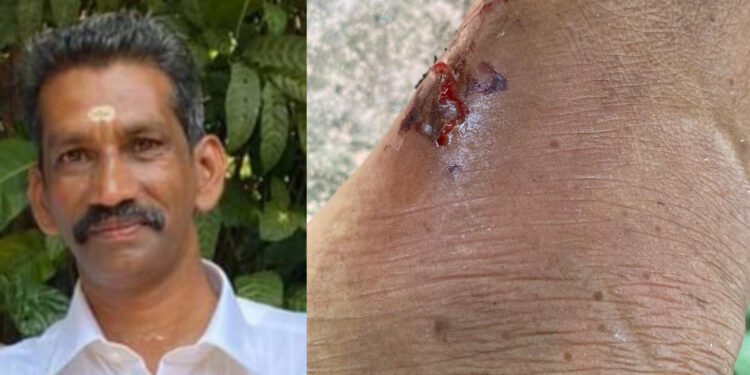ബ്ലോക്ക് പഞ്ചായത്ത് അംഗത്തിന് തെരുവ് നായുടെ കടിയേറ്റു